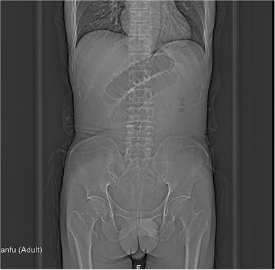 A Rare Cause of Small Bowel Obstruction: A Case Report